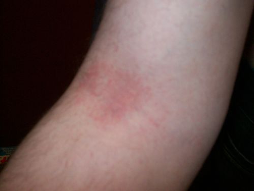 rash on inside of elbows